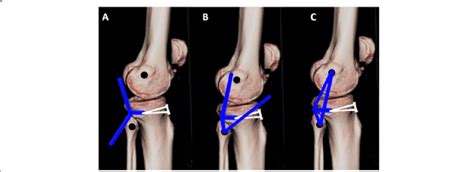 Technique of PLC reconstruction. a Semitendinosus tendon autograft ...