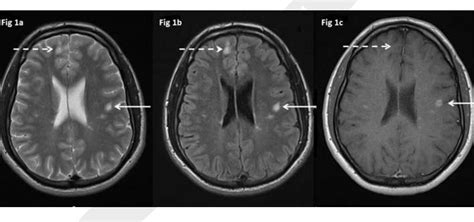 Figure 1 from Multiple sclerosis update: use of MRI for early diagnosis ...