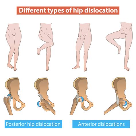 Hip Dislocation: Tua Tagovailoa’s Injury - Jeffrey H. Berg, M.D.