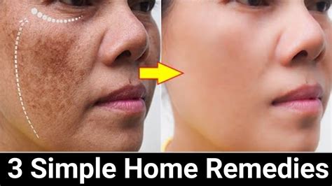 Remove Face Pigmentation Naturally. - YouTube