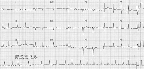 Atrial Fibrillation • LITFL • ECG Library Diagnosis