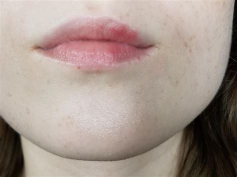 Help! Bumpy, textured, red patches on upper lip [Skin Concerns] : r ...