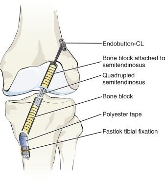 Hamstring Anterior Cruciate Ligament Reconstruction With a Quadrupled ...