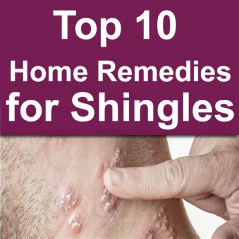 Top 10 Home Remedies for Shingles | Home remedies, Top 10 home remedies ...