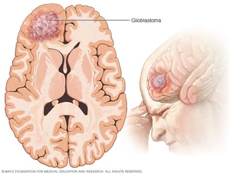 Glioblastoma - Symptoms and causes - Mayo Clinic