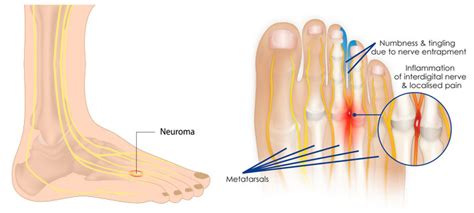 Metatarsalgia - Chicago Foot Care Clinic