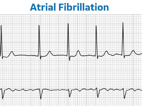 Atrial Fibrillation Vs Atrial Flutter Ecg