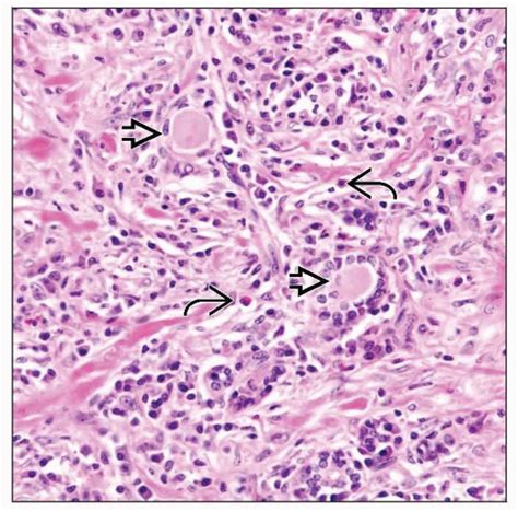 Riedel Thyroiditis | Basicmedical Key