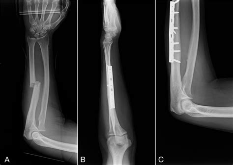 Broken Arm: Signs, Symptoms, & Treatments - Orthopedic & Sports Medicine