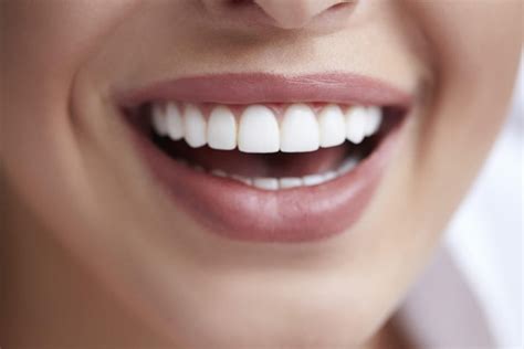 What Is the Procedure for Porcelain Veneers?