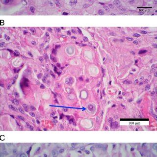 Blastomycosis Histology