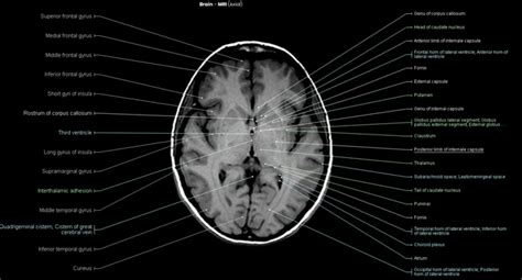 Mri Brain Anatomy