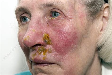 Shingles rash on the face - Stock Image C021/3416 - Science Photo Library