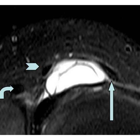 MRI and ultrasound demonstrate the meniscal cyst: (a) coronal ...