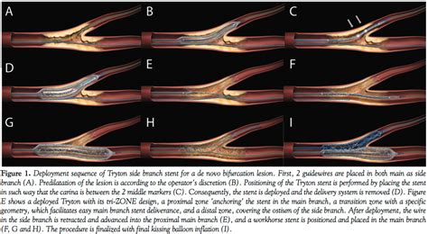 Treatment of In-Stent Restenosis Involving a Bifurcation Lesion With a ...