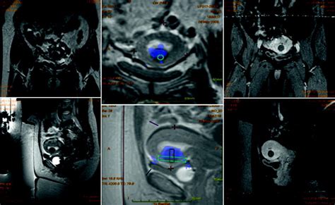 Role of Magnetic Resonance Guided Focused Ultrasound for Uterine ...