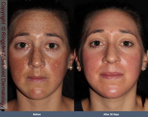 The Different Between Melasma And Hyperpigmentation | Justinboey