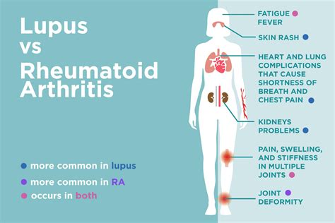 Lupus Vs Rheumatoid Arthritis