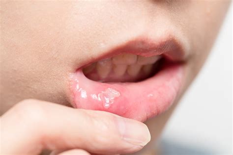 Treatment for Mouth Ulcer - Facty Health