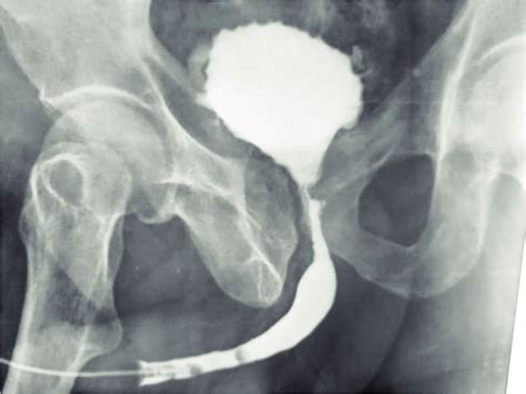 Retrograde opacification of the urethra showing a bladder neck stenosis ...