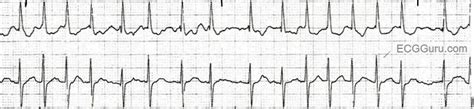 A Fib | ECG Guru - Instructor Resources