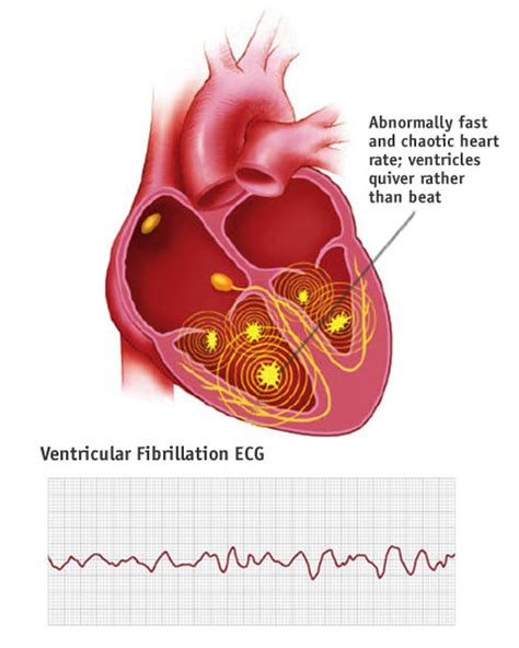 What is ventricular fibrillation (VF)? – CPR Test