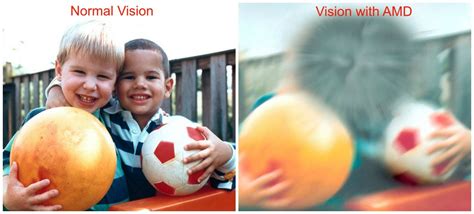 Macular Degeneration. What You Need to Know – www.scottsdaleeye.com