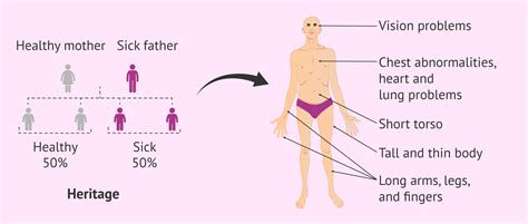 marfan-syndrome