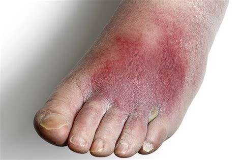 Cellulitis - Symptoms and causes