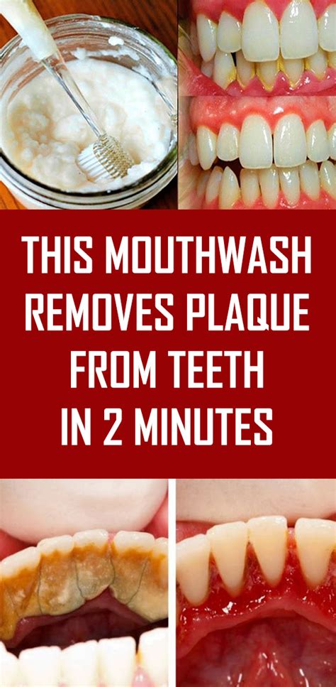 Mouthwash Removes Plaque From Teeth In 1 Minute - Theraphy 2