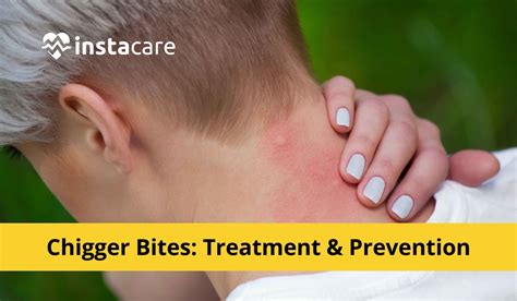 Chigger Bites Pictures, Symptoms, Causes, Treatment, And Prevention