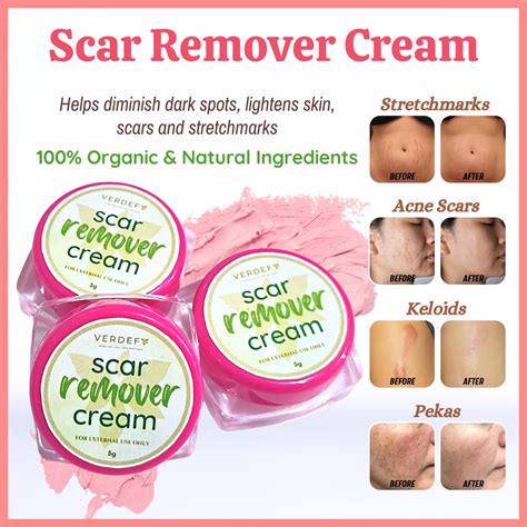 Keloid & Stretch mark Remover Cream Scar Remover Cream MIRACLE CREAM ...