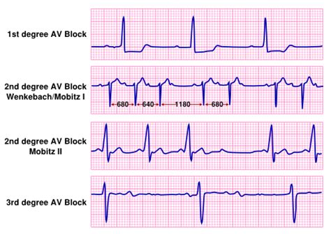 Atrioventricular Block