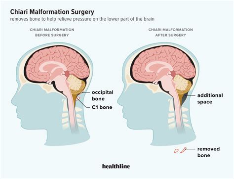 Arnold Chiari Malformation Eye Problems - Infoupdate.org