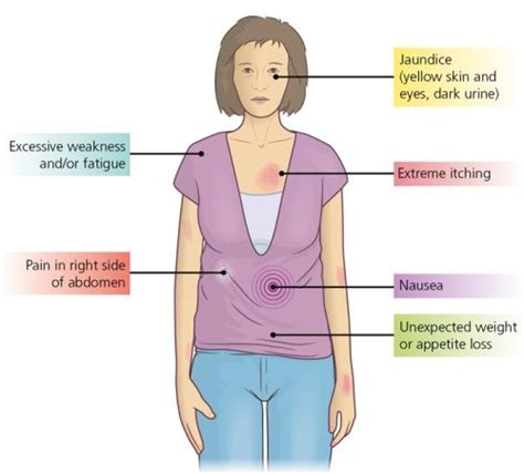 What Is Cholangiocarcinoma, How Does It Develop and What Are Its ...