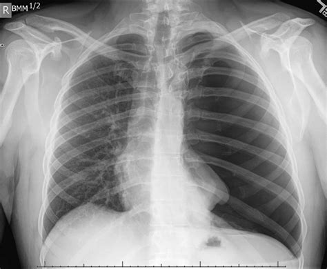 Pneumothorax Imaging