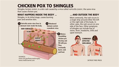 What you need to know about shingles infections