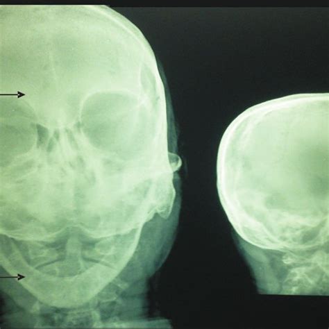 Magnetic resonance imaging (MRI) of the brain showing pontine infarct ...