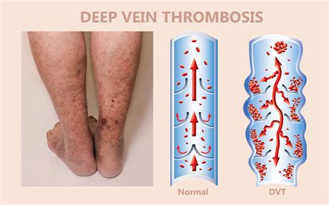 Understanding DVT and The Symptoms - Deep Vein Thrombosis