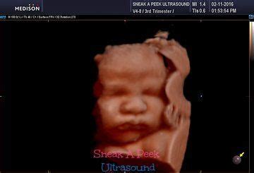 Photo from 35 Week HD collection by Sneak A Peek Ultrasound | Prenatal ...