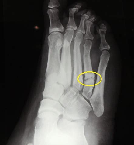 Metatarsal Fracture Specialist Treatment | 🏥Singapore Orthopaedic ...