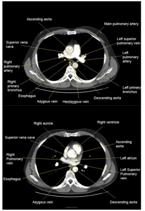 CT Chest Imaging for Radiology Students