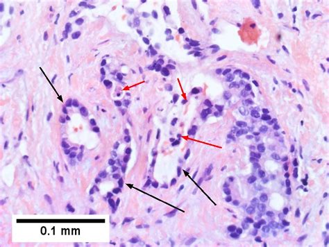 Cholangiocarcinoma - Libre Pathology