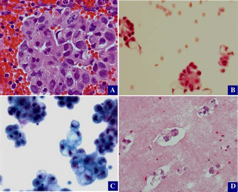 Cytologic features of ovarian epithelial cancer. Ovarian epithelial ...