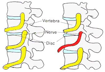 Pinched Nerve In Neck - Symptoms, Causes & Treatments