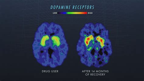 Can ‘Nova’ showing us what brains really look like on drugs change the ...