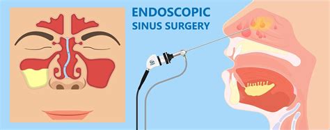 Endoscopic sinus surgery cost in india - #1 Sinus Doctor in Hyderabad