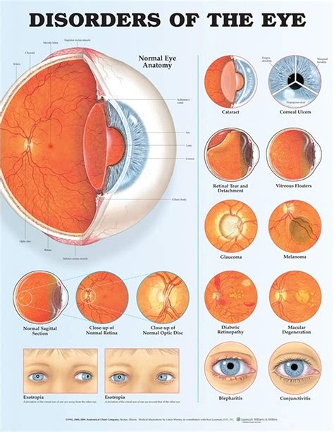 Eye Diseases Chart