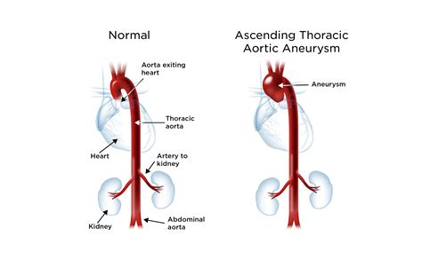 Aortic Aneurysm My Doctor Online