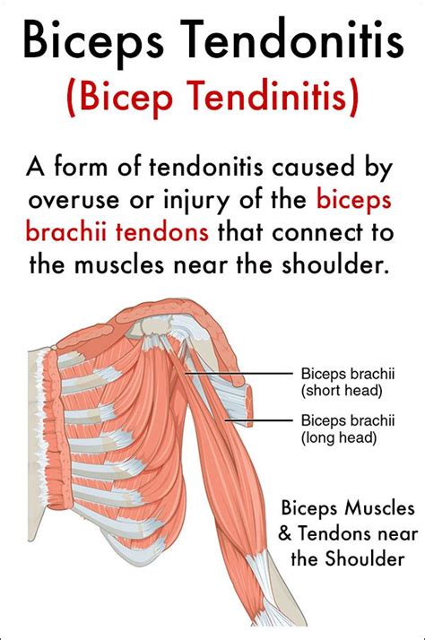 What is Biceps Tendonitis (Bicep Tendinitis)? in 2021 | Bicep ...